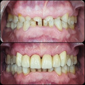 Erosión Dental, desgastes y bruxismo / Dental Carmina Parra