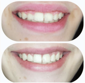 Remodelado gingival / Dental Carmina Parra