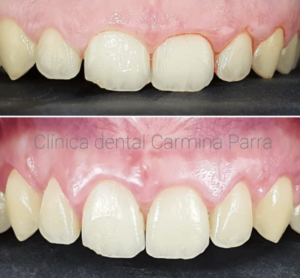 Remodelado gingival / Dental Carmina Parra