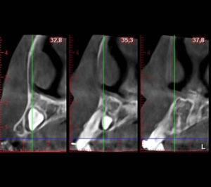 Tratamiento de caninos incluidos / Dental Carmina Parra