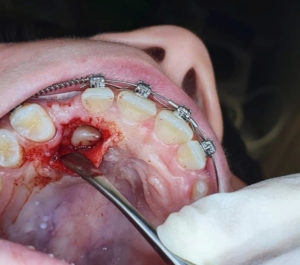 Tratamiento de caninos incluidos / Dental Carmina Parra
