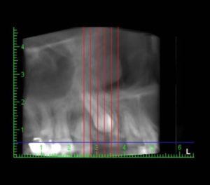 Tratamiento de caninos incluidos / Dental Carmina Parra