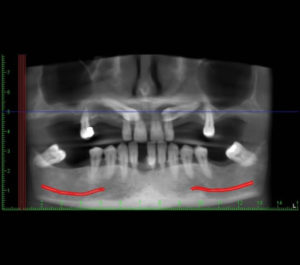 Tratamiento de caninos incluidos / Dental Carmina Parra