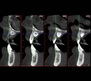 Tratamiento de caninos incluidos / Dental Carmina Parra