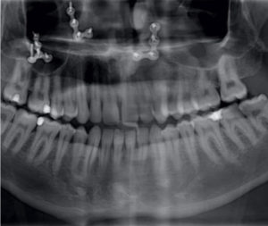 Cirugía ortognática / Dental Carmina Parra