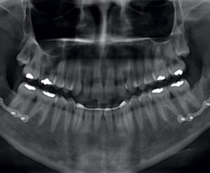 Cirugía ortognática / Dental Carmina Parra