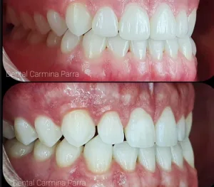carillas, carillas no-prep y coronas bopt / Dental Carmina Parra